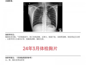 100%胸片曝光率软件，助力提升胸片拍摄效果