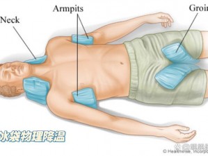 冰袋：帮助发热病人物理降温