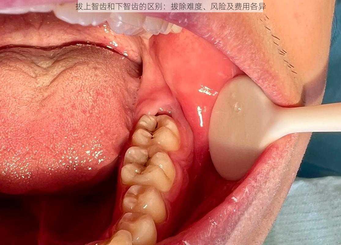 拔上智齿和下智齿的区别：拔除难度、风险及费用各异