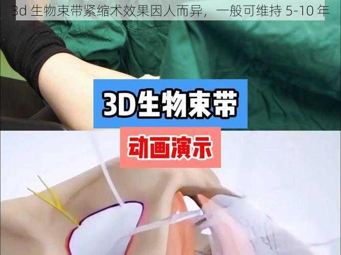 3d 生物束带紧缩术效果因人而异，一般可维持 5-10 年